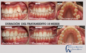 Ejemplos reales de Ortodoncia: antes y después