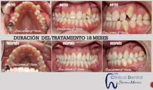 Ejemplos reales de Ortodoncia: antes y después