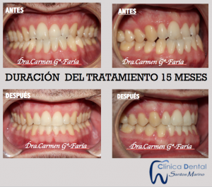 Ejemplos reales de Ortodoncia: antes y después