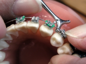 ¿Por qué es importante la ortodoncia?