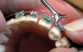 ¿Por qué es importante la ortodoncia?