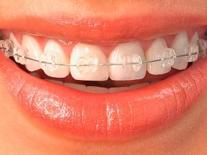 Tipos de brackets