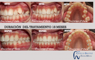 Ejemplos reales de Ortodoncia: antes y después